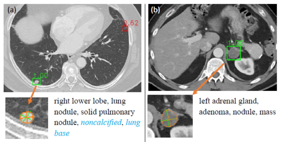 lesion detection, tagging, and segmentation results